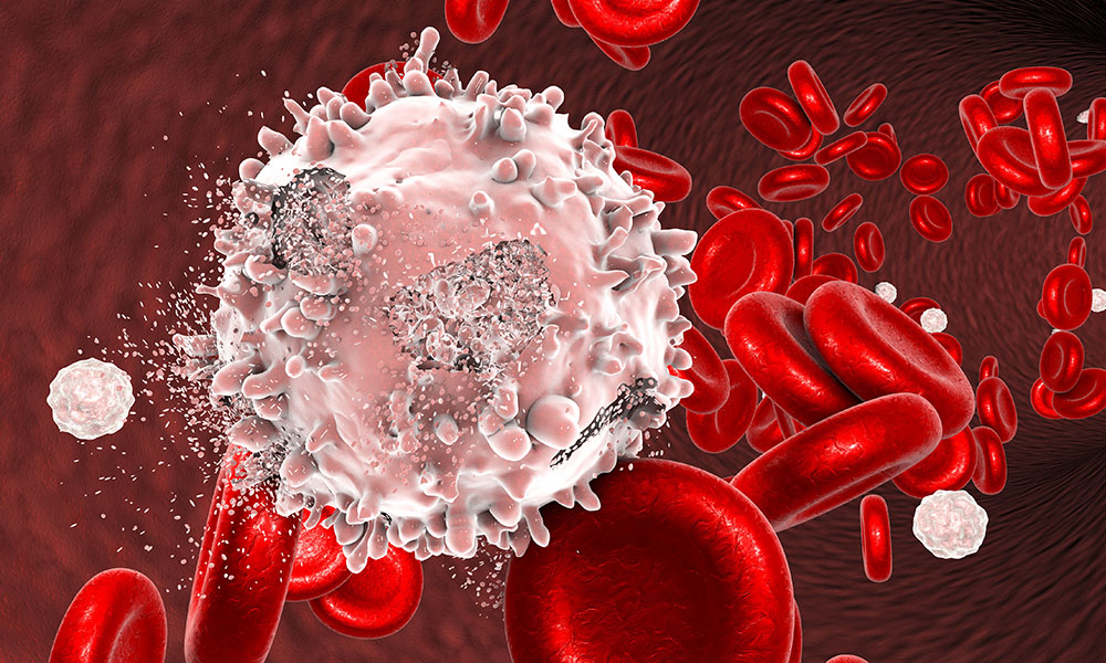Leucemias: Tipos, sintomas e opções de tratamento